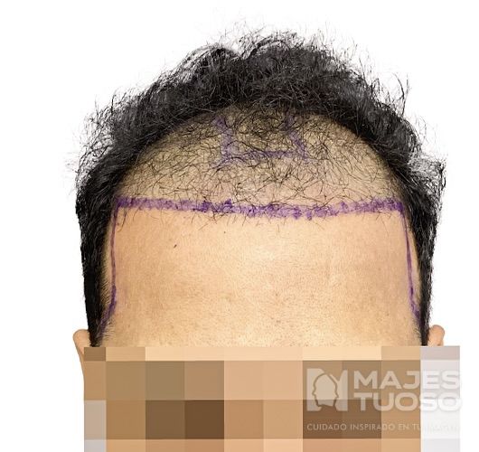 Antes · Caso 1 · Línea frontal · Dr. Jhanes Calcaño
