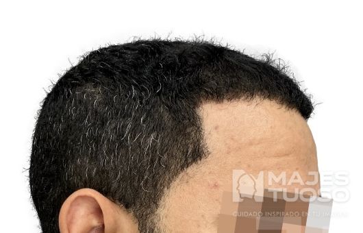 Después · Caso 2 · Línea frontal · Dr. Jhanes Calcaño