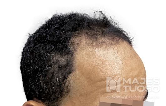 Antes · Caso 2 · Línea frontal · Dr. Jhanes Calcaño