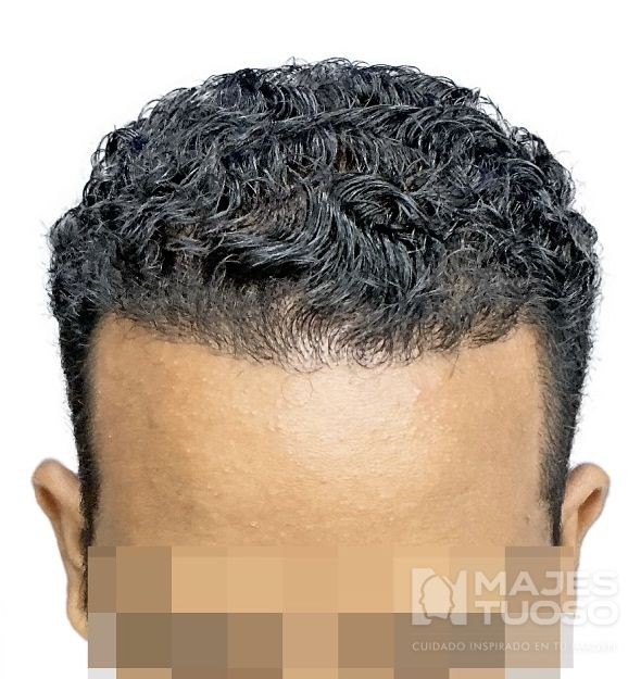 Después · Caso 3 · Línea frontal · Dr. Jhanes Calcaño