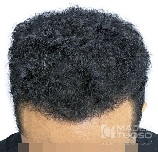 Después · Caso 4 · Frontal y zona superior · Dr. Jhanes Calcaño