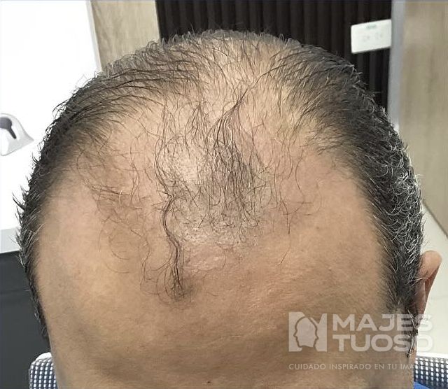 Antes · Caso 7 · Frontal y zona superior · Dr. Jhanes Calcaño