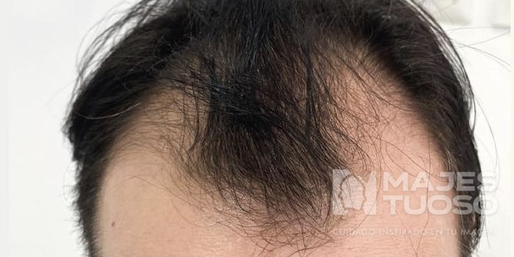 Antes · Caso 8 · Línea frontal · Dr. Jhanes Calcaño