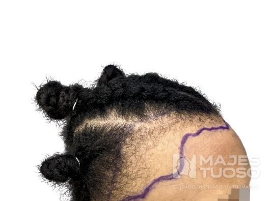 Antes · Caso 12 · Línea frontal femenina · Dr. Jhanes Calcaño